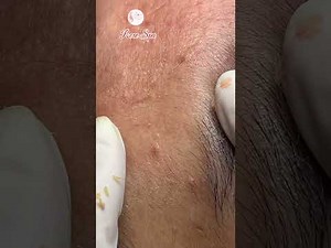 Effective acne treatment | Eliminate hidden acne and blackheads – Rose Spa Vietnam