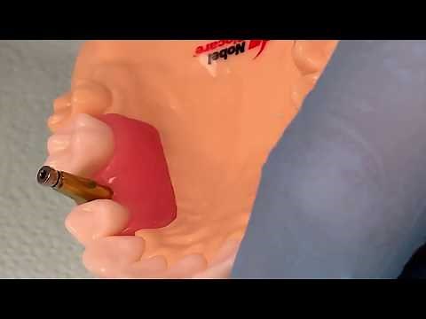 Implant Level Impression - Closed Tray Technique