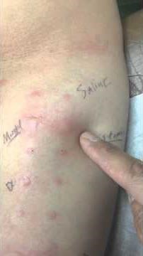 Final allergy skin test