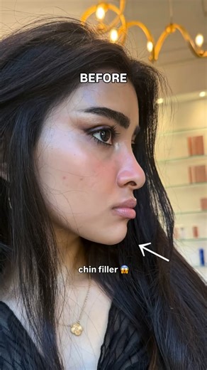 Use code SAMARA15 🫶 @skinatomylaserclinic Procedure: Chin Filler Ad - #SkinatomyLaserClinicPartner #toronto #skinatomylaserclinic #torontoinfluencer #skincareroutine #makeup #beautytips #beauty #medspa #injector #roundface #chinfiller #fillers #filler #botox #plasticsurgery #plasticsurgeon #torontoblogger #torontobloggers #torontocreator #mississauga #toronto #brampton #ontario #greatertorontoarea #beautyhacks #samaraalam #canada #usa #roundface ________________ 🛑 This content is strictly for 
