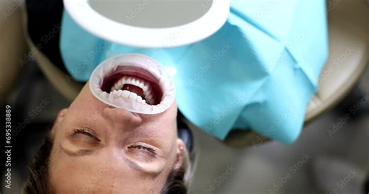 Woman with beautiful even teeth with retractor lying at dentist appointment 4k movie slow motion. Dental care concept