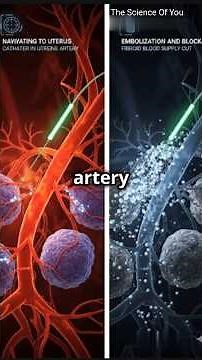 "Uterine Artery Embolization: A New Method of Surgery!"