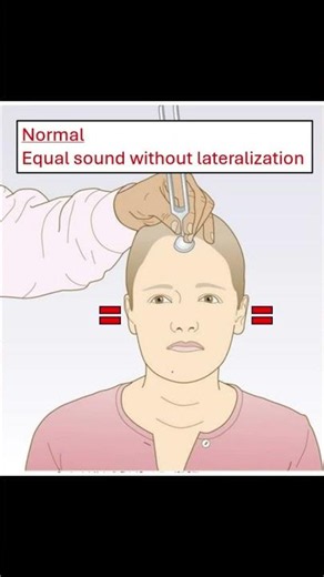 🔊 Weber Test for Hearing Loss #neurology #ENT #hearingloss #physicalexam #meded #clinicalskills
