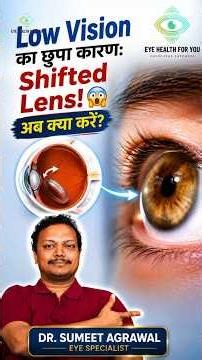 When Can Lens Dislocation Become a Serious Problem? 👁️ Marfan Syndrome Explained! 😨 | Dr. Sumeet ...