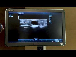 Ganglion cyste of an A1 Pulley by Carlo Martinoli