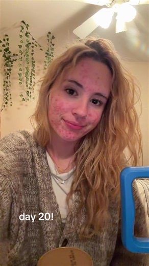 Navigating Acne with Confidence: Day 20 Journey