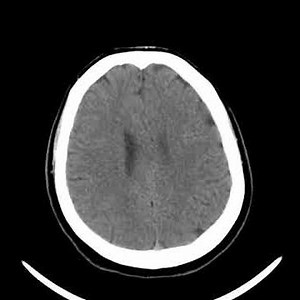 Intracranial calcifications on head CT