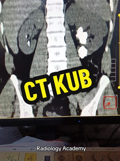 Understanding CT KUB Diagnosis in Radiology