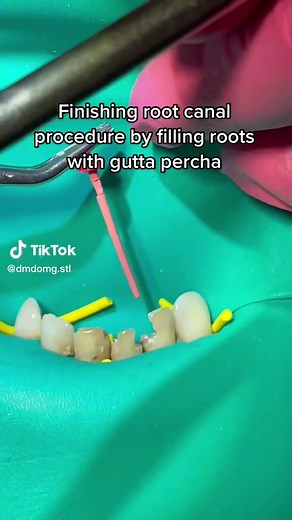 Finishing root canal procedure by filling roots with gutta percha. #rootcanal #rootcanalprocedure #rootcanalprocess #rootcanalsurgery #rootcanalfilling #dmdomg #teethcare #dentistry #dentalstudent #dentaleducation #foryoupage #teethcare #dentalvideo #dentista