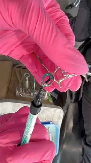 Braces on and palatal expander in 🦷 Here are the steps for phase I braces #braces #expander #crossbite #wildsmiles #braceface #orthodontist #dentist #dentalassistant | The Braces Guy