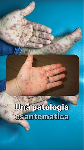 Dott. Francesco Signorello on Instagram: "Malattia mani-piedi-bocca È un’infezione virale causata da enterovirus, in particolare il Coxsackievirus A16 e l’Enterovirus 71. Si manifesta con vescicole dolorose su mani, piedi e mucosa orale, spesso accompagnate da febbre e malessere generale. Curiosità: La trasmissione avviene per via oro-fecale, tramite saliva o contatto con superfici contaminate. La guarigione avviene spontaneamente in 7-10 giorni, ma è importante evitare il contatto ravvicinato p
