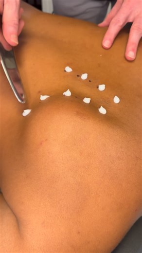 🏆 Instrument Assisted Soft Tissue Mobilization (IASTM) helps break up scar tissue and fascial restrictions using specially designed tools. This technique promotes better circulation, restores mobility, and speeds up recovery from overuse or injury. #IASTM #SoftTissueTherapy #ChicagoChiropractic #Chiropractor#drkyleross | Dr_kyleross