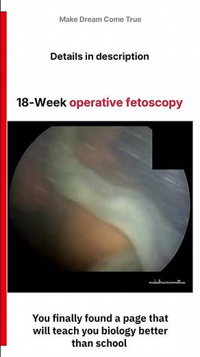 🤰🏻18-Week Operative Fetoscopy 🔬 | MDCT