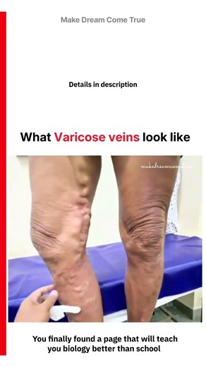 🦵🏻 What Varicose Veins look like 🧑‍⚕️ | MDCT