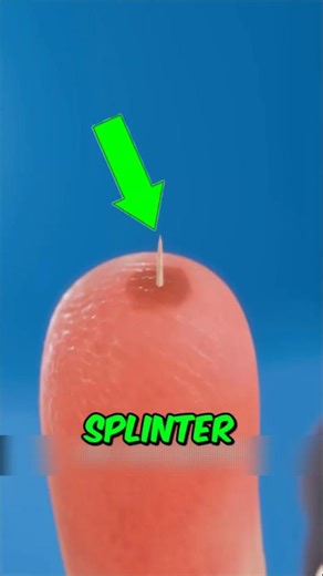 Never Ignore a Splinter, Here’s Why?