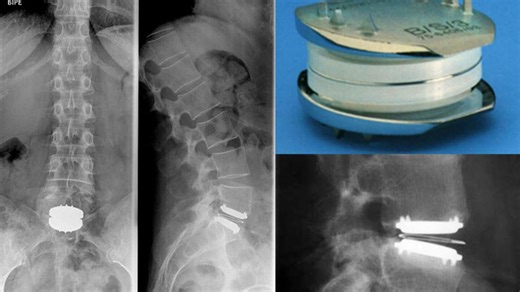 La prótesis de disco lumbar, un descanso para la espalda