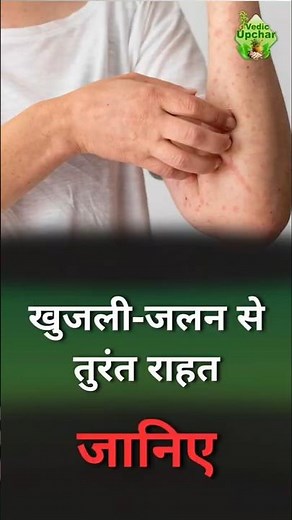 Itching and Burning on Skin Tips? Easy Home Remedies | Vedic Upchar | | #shorts #skincare #skin