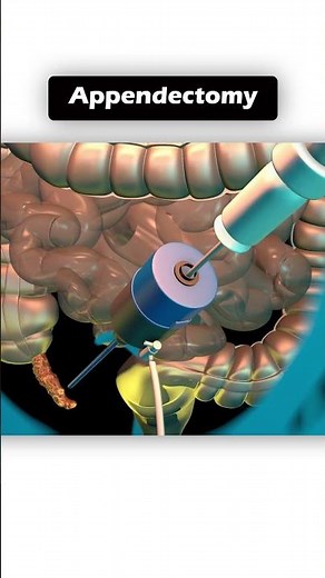 #Appendectomy #Appendicitis #SurgeryExplained #MedicalShorts #LaparoscopicSurgery #EmergencySurgery