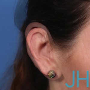 Macrotia Ear Reduction