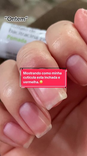 Cutícula Inchada e Vermelha: O Que Fazer?