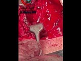 Parathyroid Blood Supply Preservation • Video • MEDtube.net