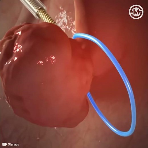 Removal of a Colon Polyp: 3D Animated Colonoscopic Polypectomy #medical #animation #shorts