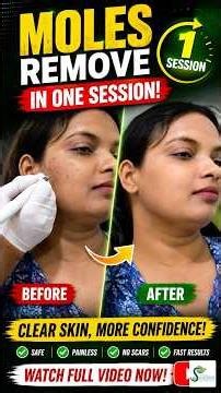 Mole Removal in One Session | Quick & Safe Skin Treatment #MoleRemoval #SkinTreatment #Skincare