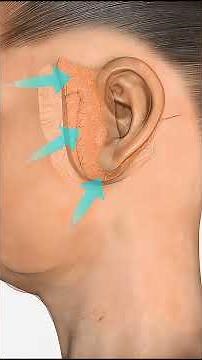 Facelift Surgery Procedure (3D Animation) #facelift