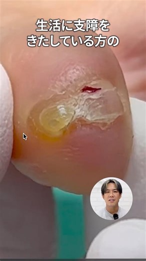 【施術動画】足の小指が激痛で生活に支障がでている！副爪の施術を解説します！