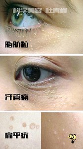 脂肪粒、汗管瘤、扁平疣怎么辨别？杜青峰