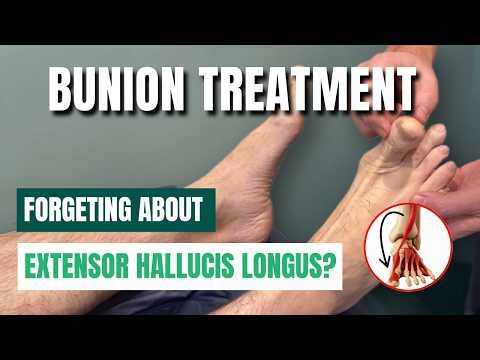Bunion Treatment: Are you forgetting about extensor hallucis longus?