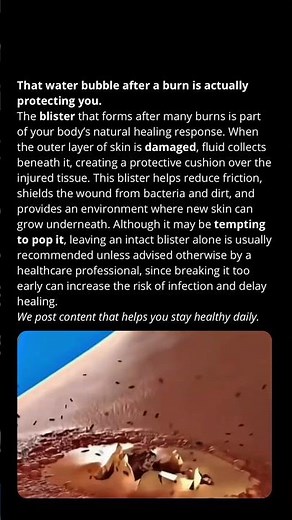 That water bubble after a burn is actually protecting you.