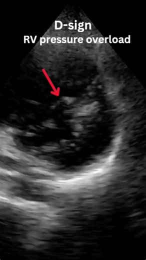D-Sign on Echocardiography | RV Pressure Overload