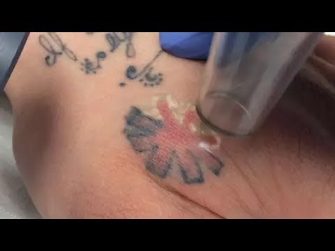 Best Tattoo Removal You Do it Yourself at Home