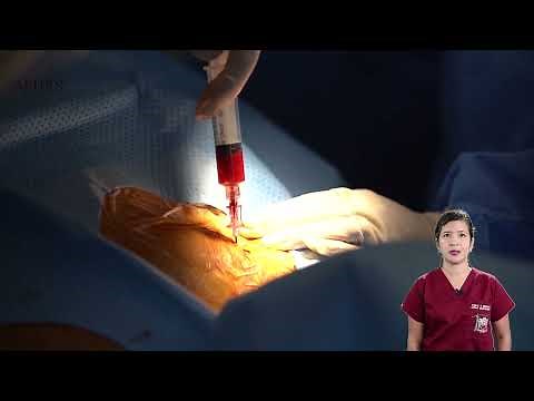 Dr Gervacio Patient 1 Chapter 2 Axillary Vein Access