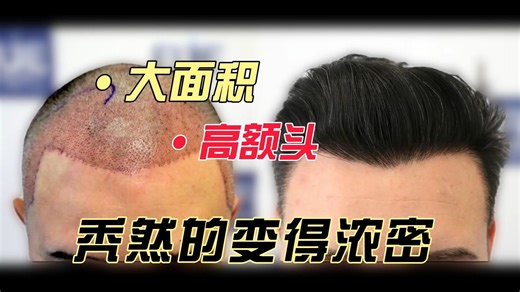 植发前后大对比！这效果堪称换头术
