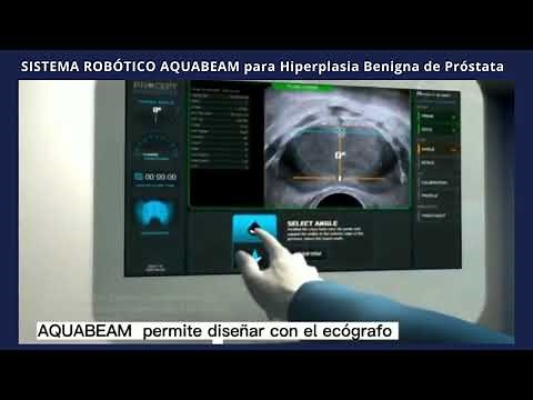 Sistema robótico aquabeam la técnica avanzada y mín. invasiva para hiperplasia benigna de próstata