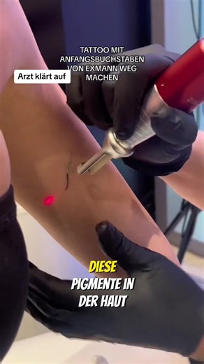 Tattoo Entfernung mit Laser: Prozess & Funktion erklärt