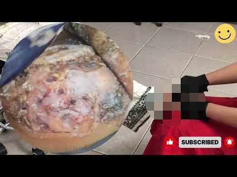 🔍 Unseen Jigger Cavities – Hardened Dry Skin Lifted Off Fully! #PD266