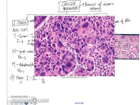 Neoplasia: Grading and Staging