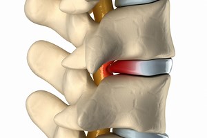 Average Bulging Disc Compensation After an Accident | Console & Associates P.C.