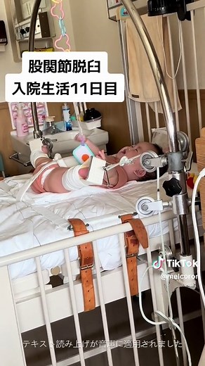 赤ちゃんの股関節脱臼治療の記録