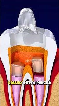 How Root Canal Treatment Is Done (3D Animation)