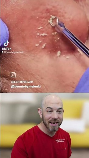 What are Sebaceous Filaments? (Nose Extraction)