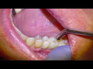 [1] Dental Implant Bridge Installation