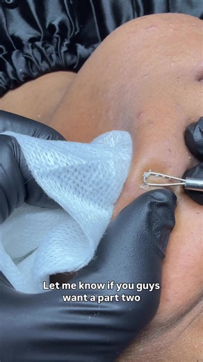 Essential Tips for Comfortable Extractions as an Esthetician