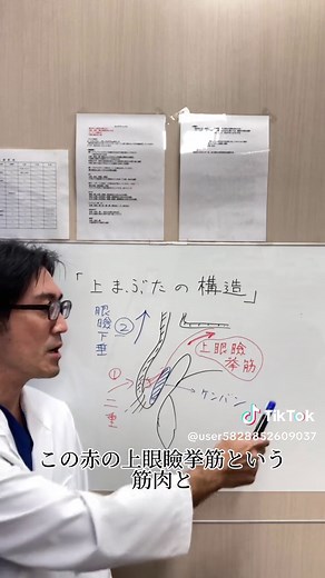 【上まぶたの構造】 目の開く仕組みや二重ができる仕組みについて、簡略化して説明しています。 上眼瞼挙筋の先にある挙筋腱膜がもっと重要ですが、ややこしいので上眼瞼挙筋と呼んでいます。 挙筋→腱膜→瞼板→皮膚や眼輪筋の位置関係が重要です。 間違いなどあればご指摘ください🙇‍♂️ 【神戸院】 しらさぎ形成クリニック神戸院 〒650-0021 兵庫県神戸市中央区三宮町1丁目2-1 日住神戸ビル6階 ☎️078-381-8323 【徳島院】 しらさぎ形成クリニック 〒770-0911 徳島県徳島市東船場町1丁目6 6階 ☎️088-602-7351 #しらさぎ形成クリニック #しらさぎ形成クリニック神戸院 #神戸 #徳島 #神戸美容外科 #神戸形成外科 #形成外科 #形成外科専門医 #美容外科専門医 #眼瞼下垂症 #眼瞼下垂 #二重 #二重整形 #二重まぶた #二重まぶた手術 #埋没法 #埋没法二重術 #切開法二重術 #切開法二重 #挙筋前転 #挙筋前転術 #挙筋前転 #眼瞼下垂 #眼瞼下垂手術