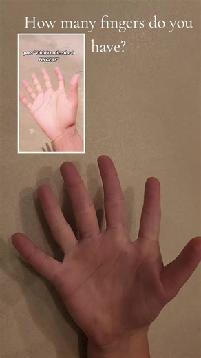 Polydactyly: Meet the Twelve Finger Girl