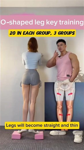 Stop Doing This! 3 Exercises to Fix O-Shaped Legs & Pigeon Toes at Home (Results in 30 Days)