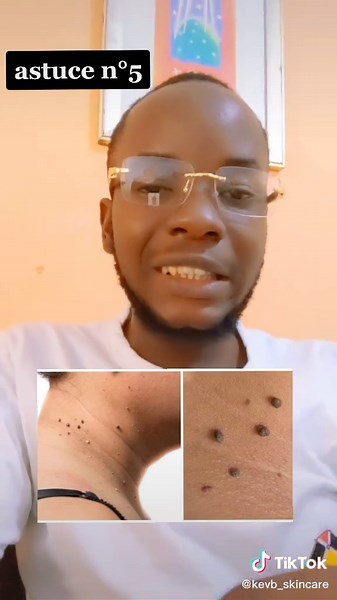 comment traiter les acrochordons ? #soinduvisage #soindelapeau #soindelapeaunaturel #routinedusoir #routinedumatin #visage #skincarefrance #percerbouton #peelingvisage #exfoliant #exfoliation #erreurbeauté #astucebeauté #astucebeaute #cequejauraisaimesavoir #scrub #scrublife #huilleessentielle #produitbio #diy #diyskincare #cremevisage #laitcorps #acnetreatment #acne #boutons #🇨🇲 #tiktokcameroun🇨🇲 #fypシ #🇨🇵 #france #viral